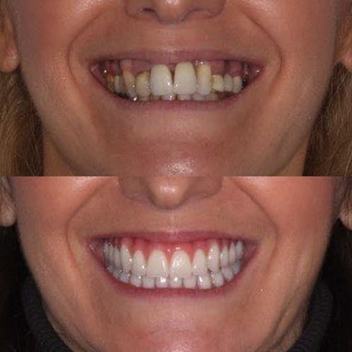 MC280321-all-on-x-rodrigues-patient-3-before-after-800x800